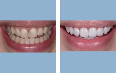 Before and After